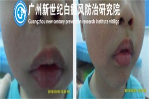 孩子患白癜风通常是什么原因