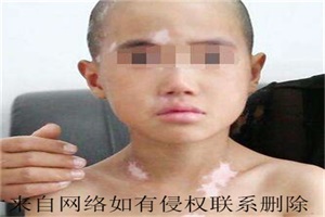 家里小孩患上白癜风该怎么治