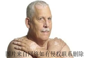 白癜风患者平常爱吃烧烤可以吗