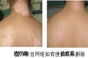 白癜风长期治不好有何危害