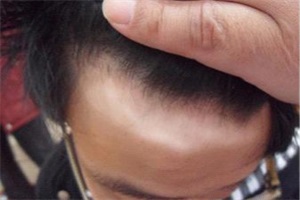 东莞白癜风患者怎么防止病情加重