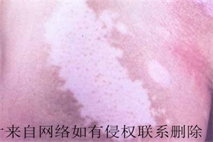 东莞女性患白癜风怎么治疗