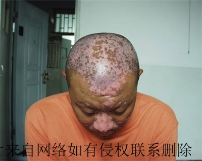 白癜风患者调节情绪怎么做