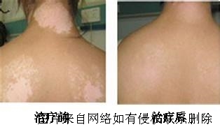 白癜风治疗大概治疗费用是多少