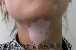 男性白癜风发病是因何因素