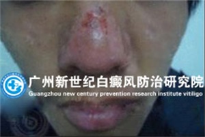 背部白癜风治疗注意些什么