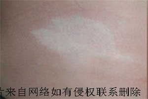 白癜风患者要防止误区治疗
