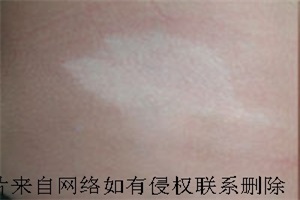 白癜风患者要防止误区治疗