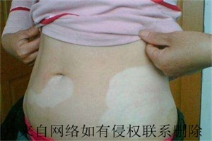 孕妇白癜风患者生活中注意什么