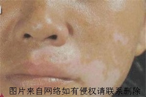 白癜风患者治疗中需要怎么做