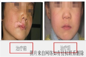 儿童白癜风有什么症状