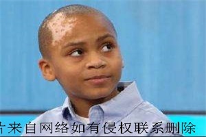 白癜风带来哪些危害